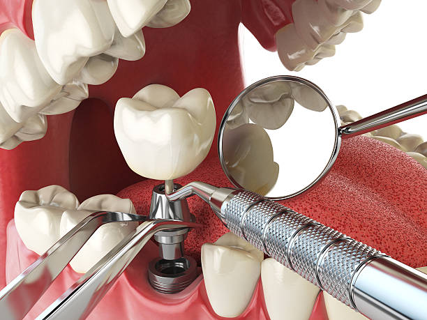 Best Emergency Dentist for Knocked-Out Tooth in White Knoll, SC